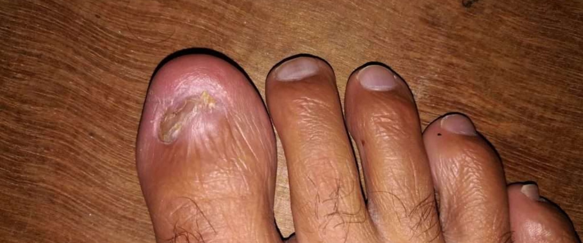 What Causes It? Ram's Horn Toenail Treatment Guide & Remedies
