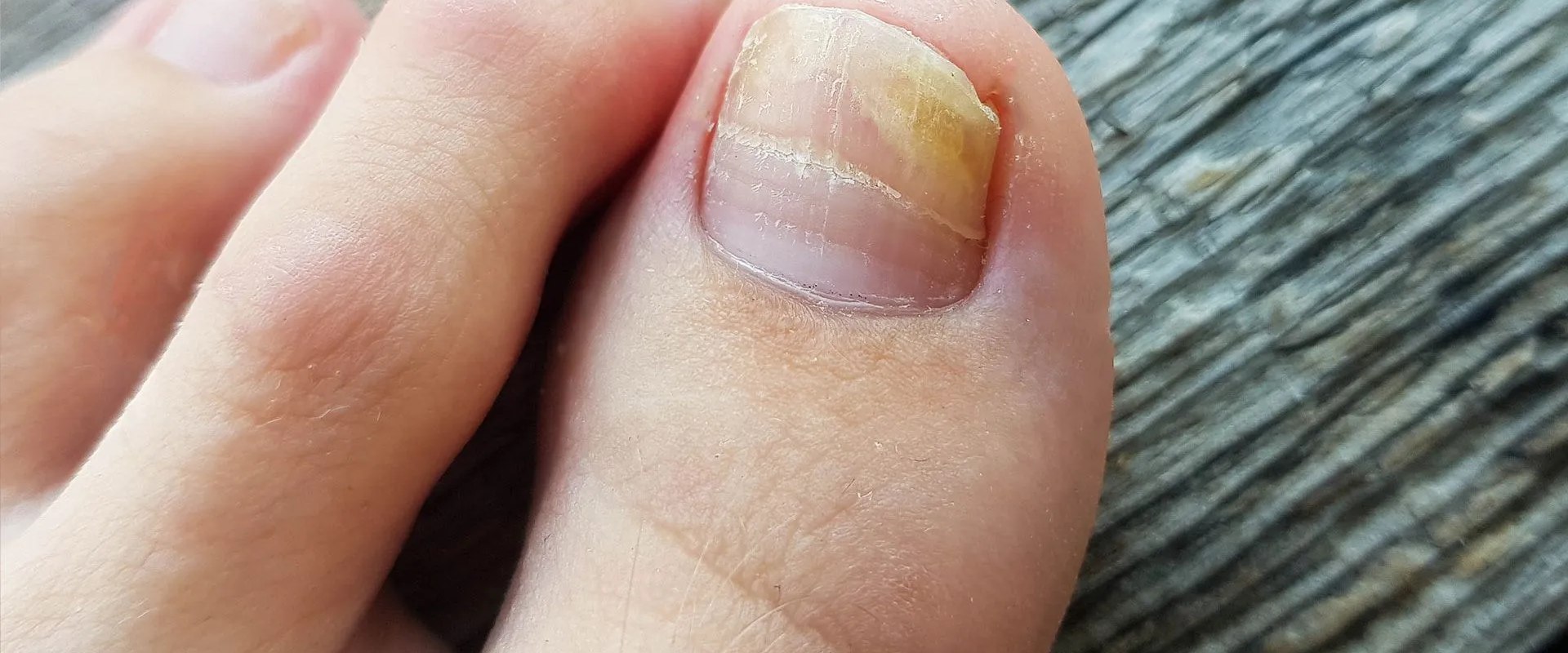 Stop the Spread Now: Stages and Pictures of Toenail Fungus with Actionable Advice