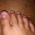 What Causes It? Ram's Horn Toenail Treatment Guide & Remedies