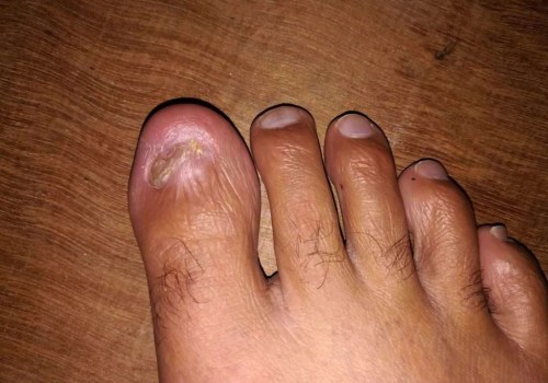 What Causes It? Ram's Horn Toenail Treatment Guide & Remedies