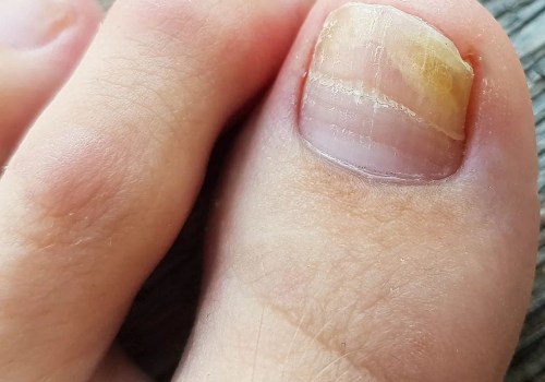 Stop the Spread Now: Stages and Pictures of Toenail Fungus with Actionable Advice